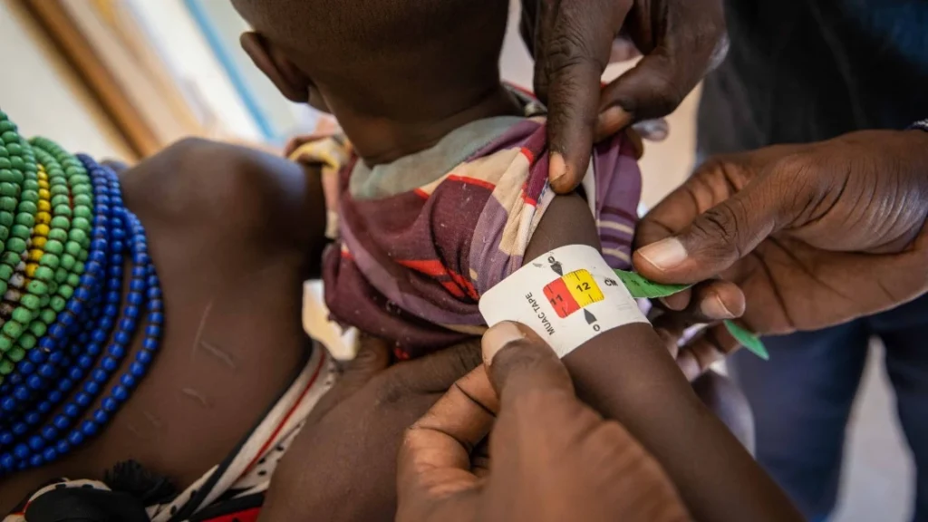 A child’s arm is measured at a malnutrition clinic in Lekwasimyen in Northern Kenya's Turkana province.
